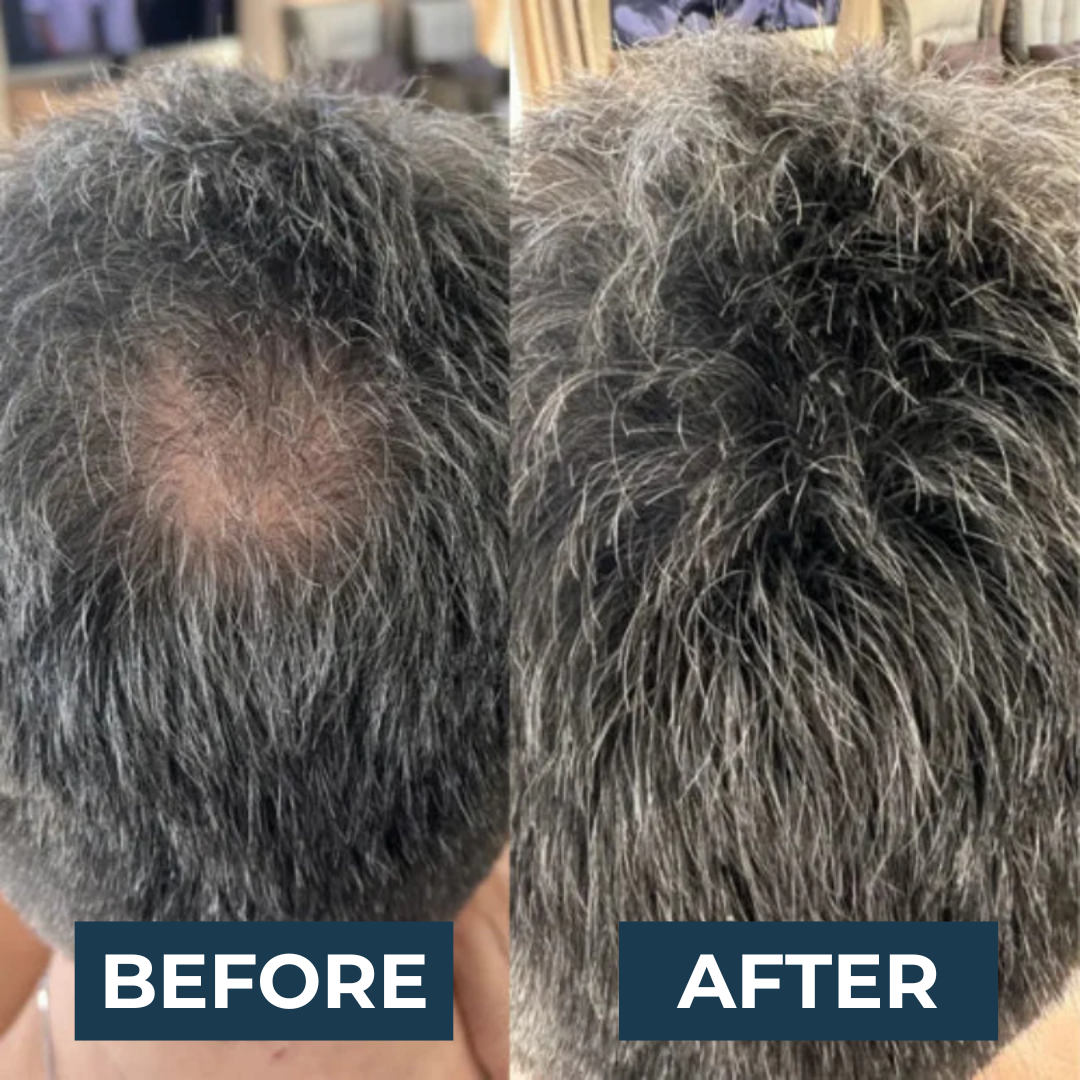 DENSIAbooster™ | Instant Hair Density