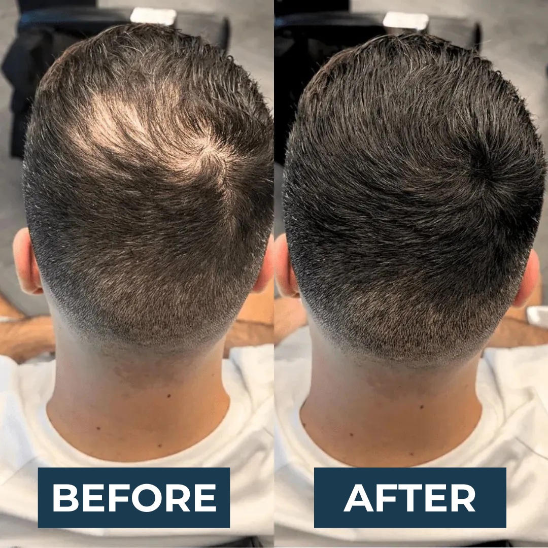 DENSIAbooster™ |  Instant Hair Density